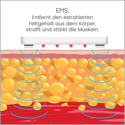 Erklärende Infografik zur Wirkung von EMS in Farbe Erklärende Infografik zur Wirkung von EMS in Farbe