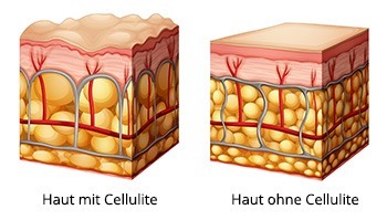 Abbildung von Haut mit und ohne Cellulite